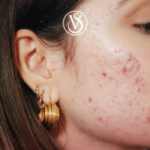 Regala(ti) una pelle senza acne